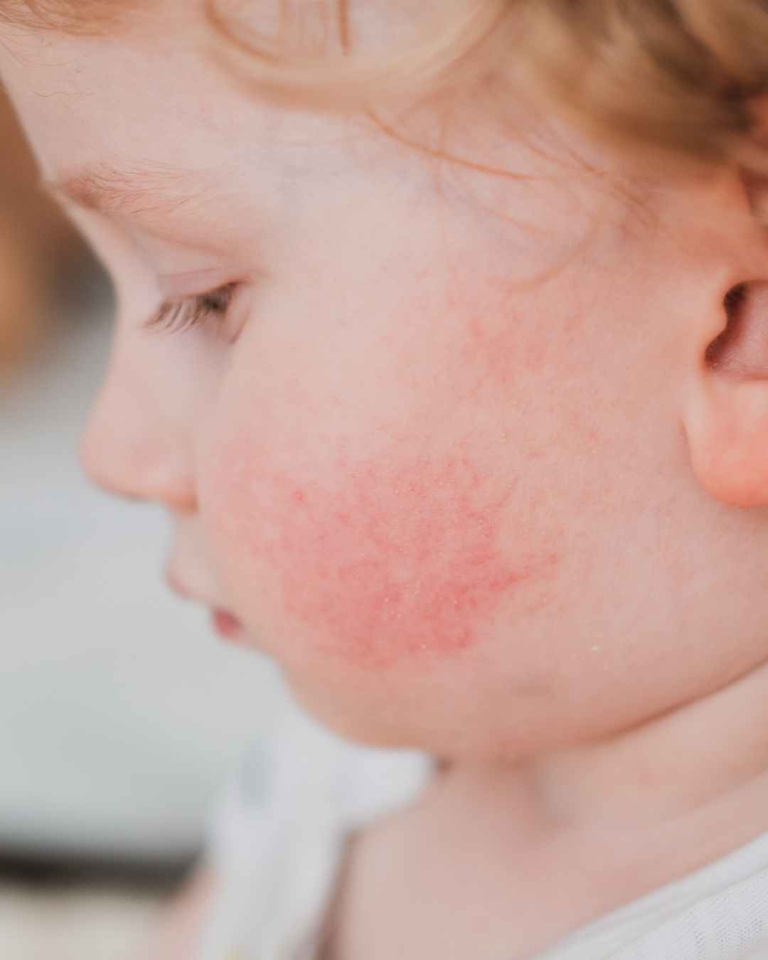 Visage rougeurs enfant BOPLUME DERMATOLOGIE