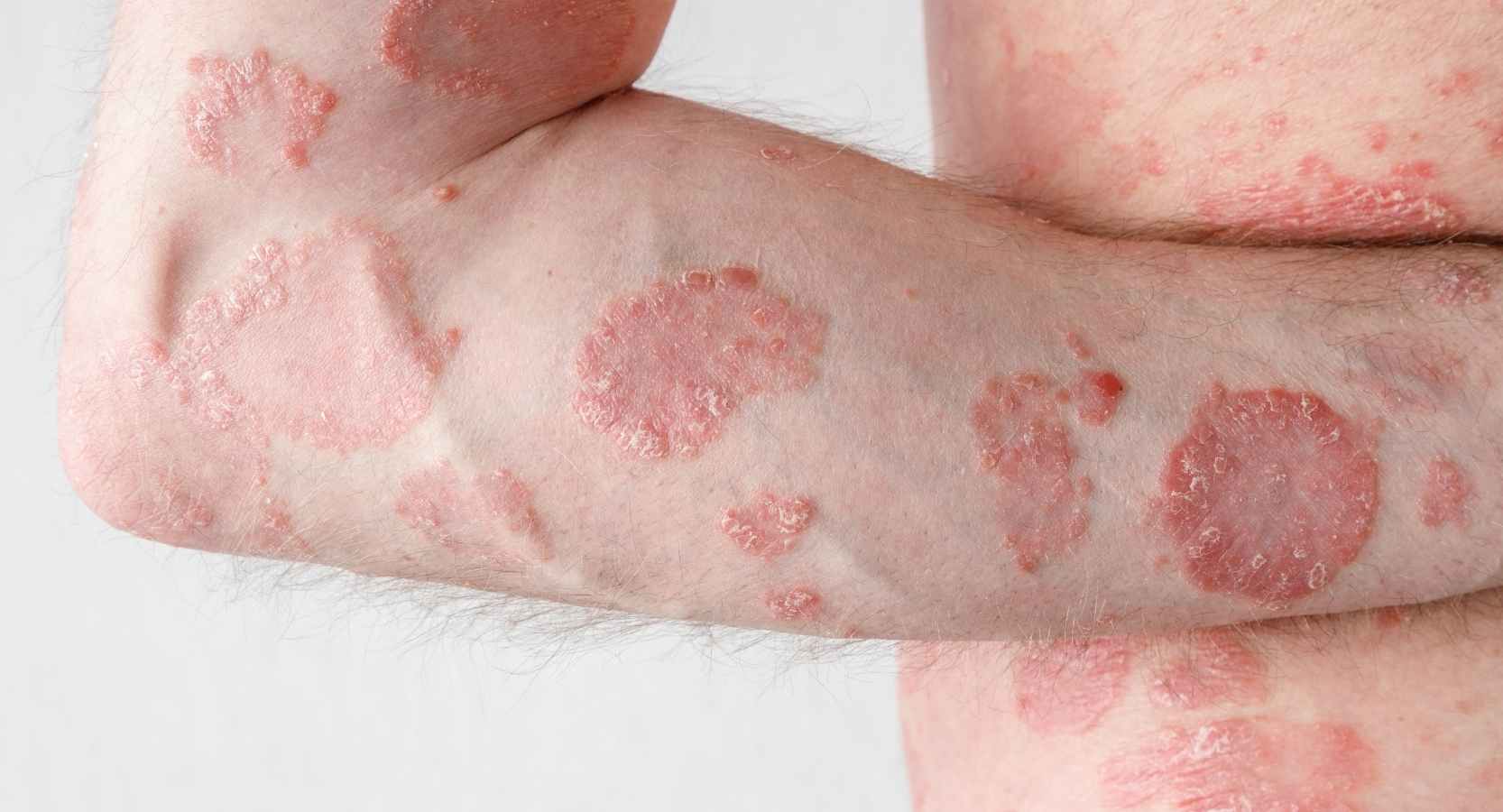 COPRS ECZÉMA NUMMULAIRE BOPLUME DERMATOLOGIE