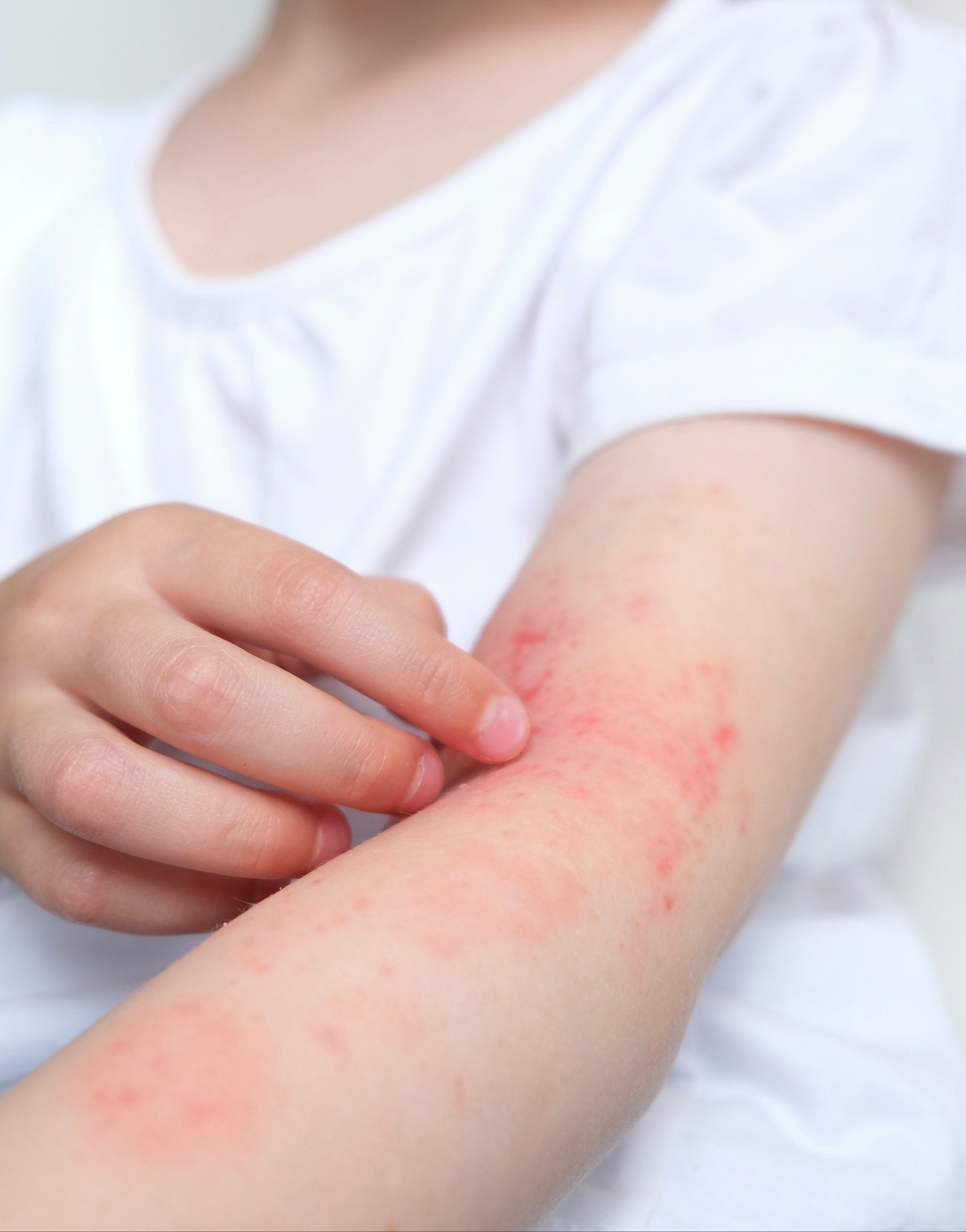 bras avec peau atopique