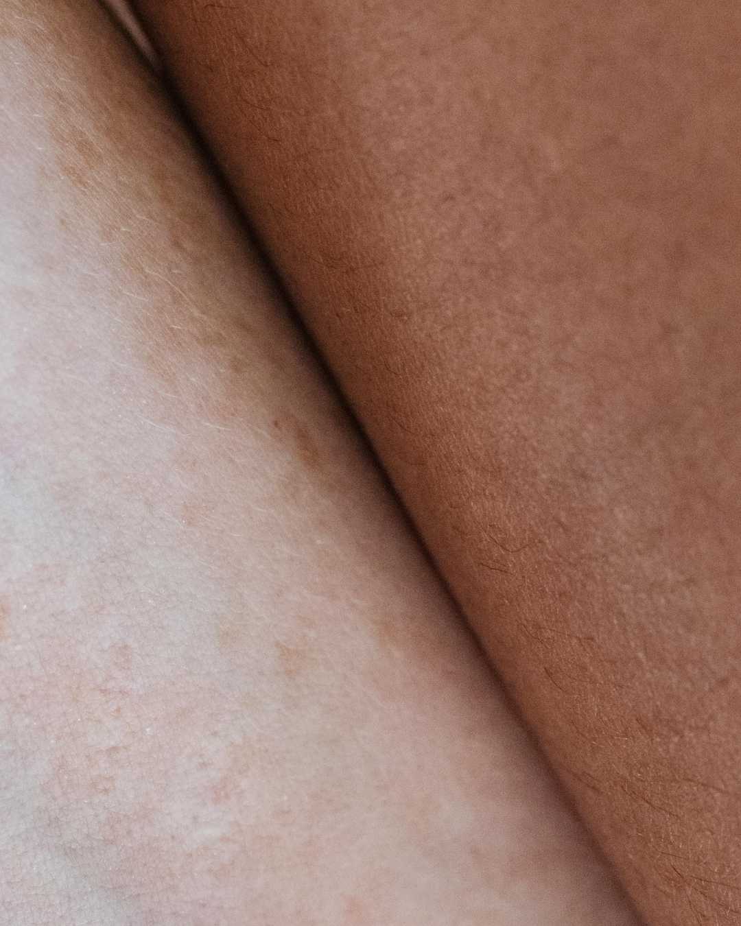 Diagnostic Peaux sèches ET TRÈS SÈCHES - Boplume Dermatologie