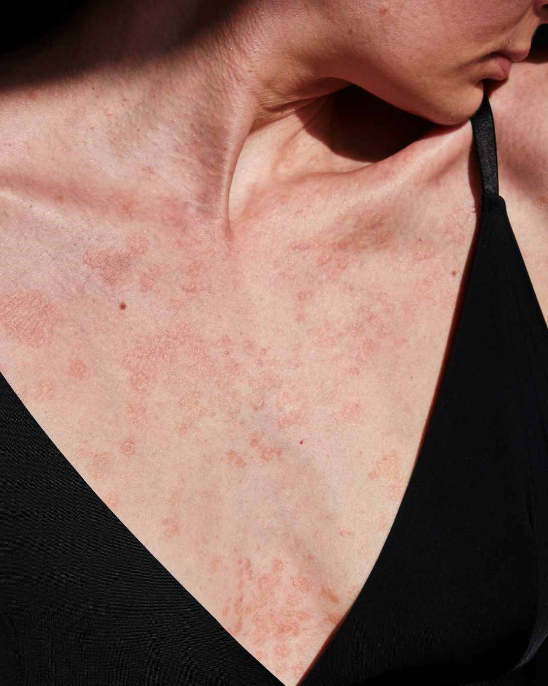 Eczéma ou psoriasis : comment faire la différence ?