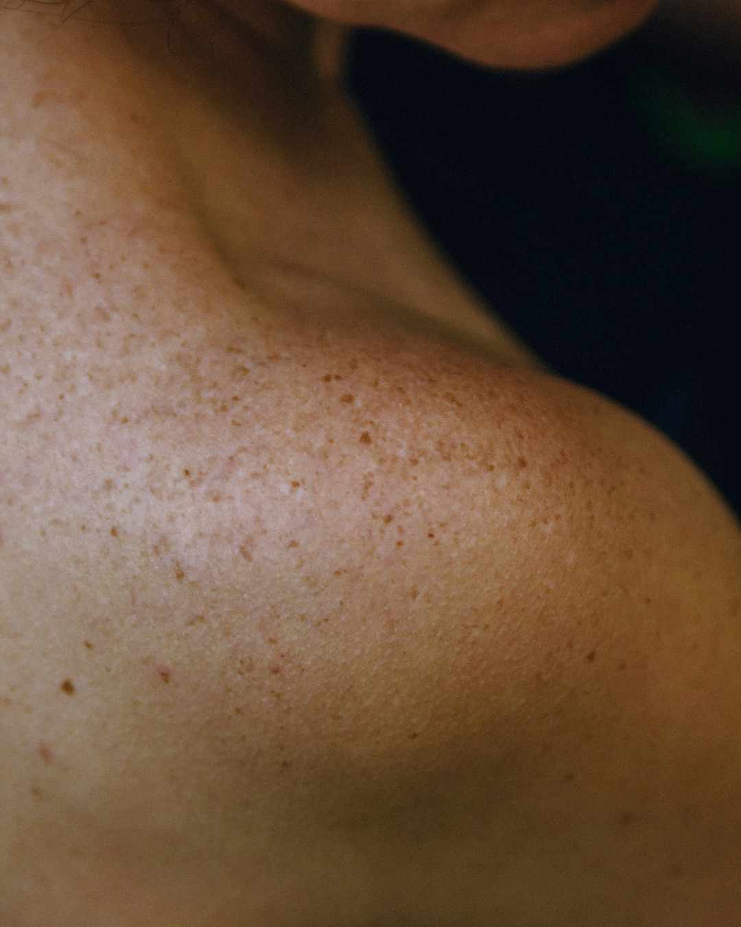 MICROBIOME CUTANÉ BOPLUME DERMATOLOGIE