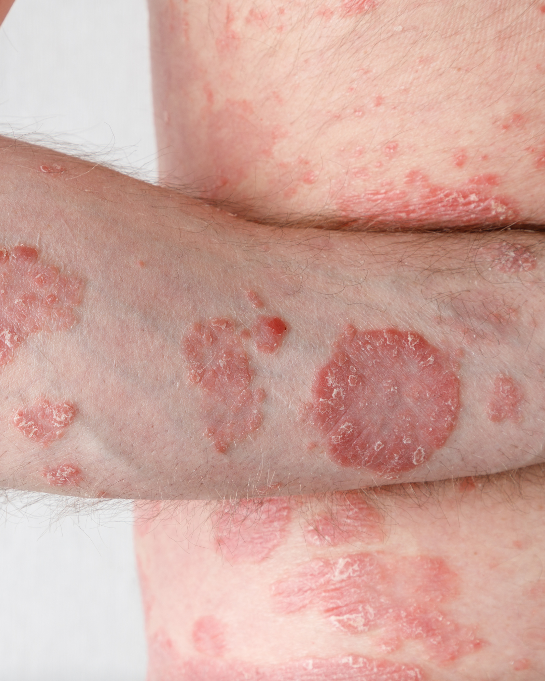 Diagnostic Psoriasis  - Boplume Dermatologie