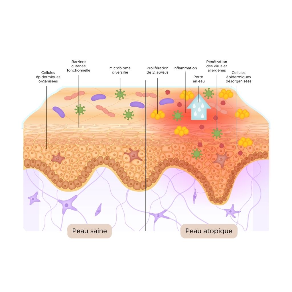 Microbiome_cutané_peau_saine_peau_atopique
